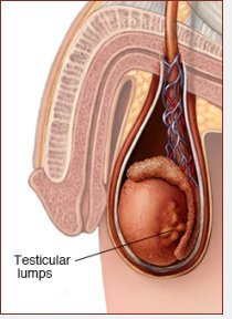 scrotal swellings